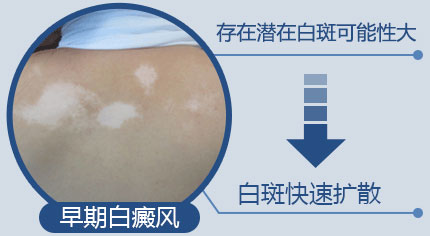 不同时期的白癜风有哪些特点呢