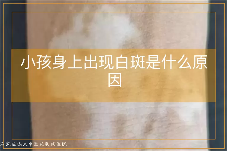 小孩身上出现白斑是什么原因
