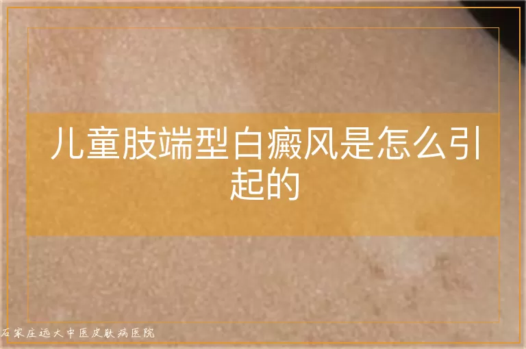 儿童肢端型白癜风是怎么引起的