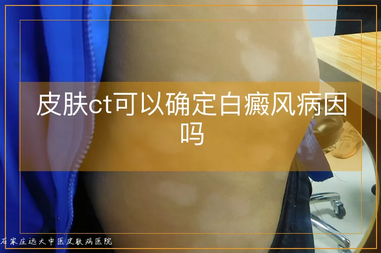 皮肤ct可以确定白癜风病因吗