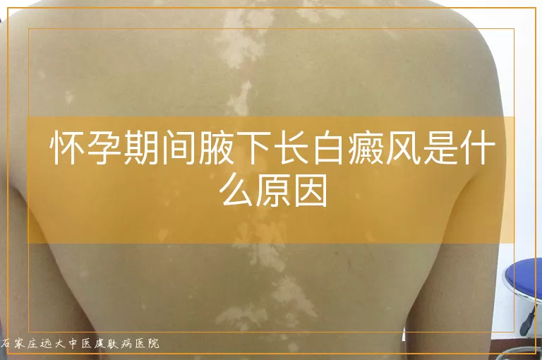 怀孕期间腋下长白癜风是什么原因