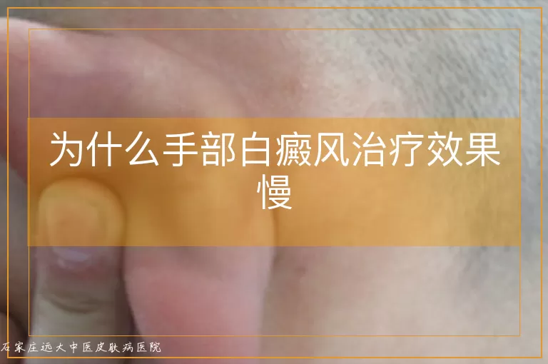 为什么手部白癜风治疗效果慢