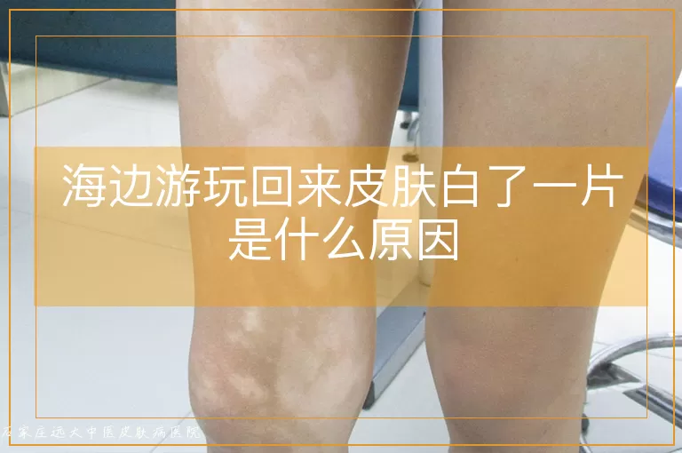 海边游玩回来皮肤白了一片是什么原因