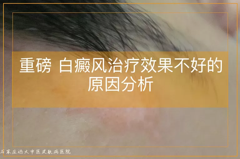 重磅 白癜风治疗效果不好的原因分析
