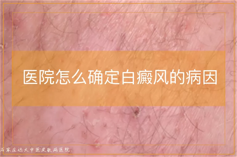 医院怎么确定白癜风的病因
