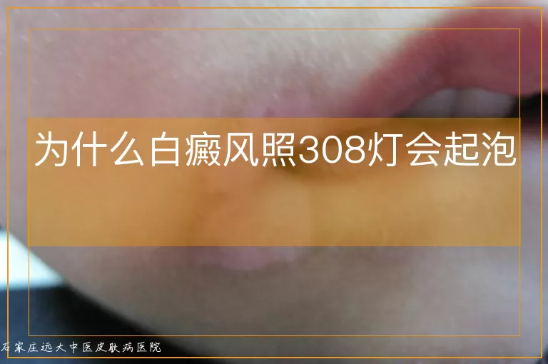 为什么白癜风照308灯会起泡
