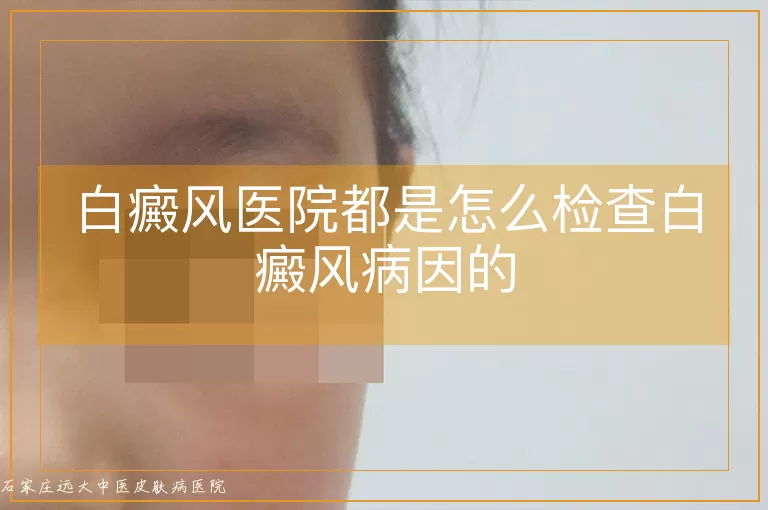 白癜风医院都是怎么检查白癜风病因的
