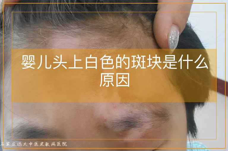 婴儿头上白色的斑块是什么原因