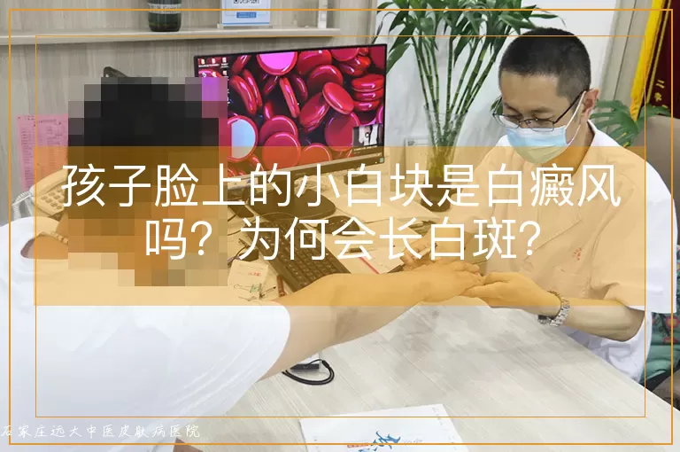 孩子脸上的小白块是白癜风吗？为何会长白斑？