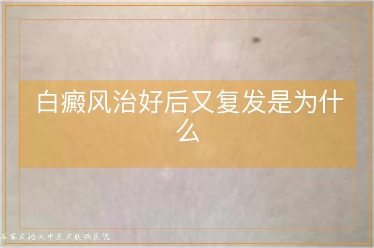 白癜风治好后又复发是为什么