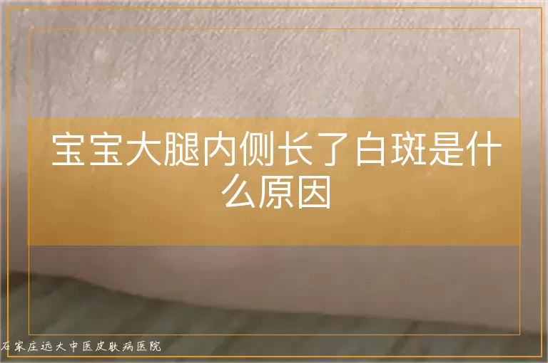 宝宝大腿内侧长了白斑是什么原因