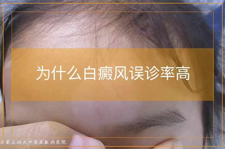 为什么白癜风误诊率高