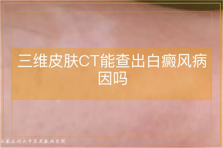 三维皮肤CT能查出白癜风病因吗