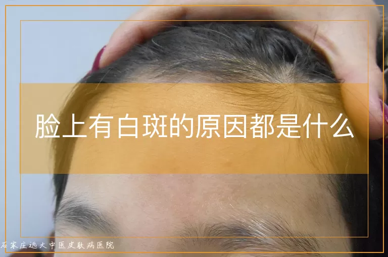脸上有白斑的原因都是什么