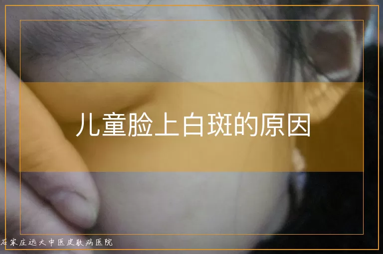 儿童脸上白斑的原因