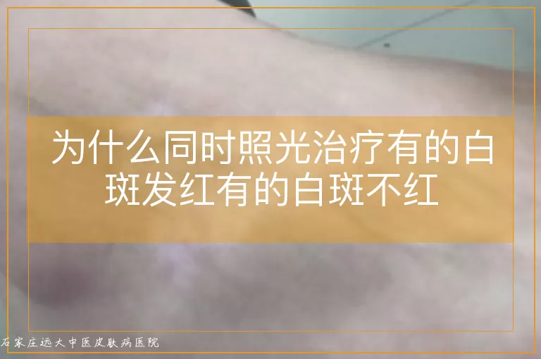 为什么同时照光治疗有的白斑发红有的白斑不红