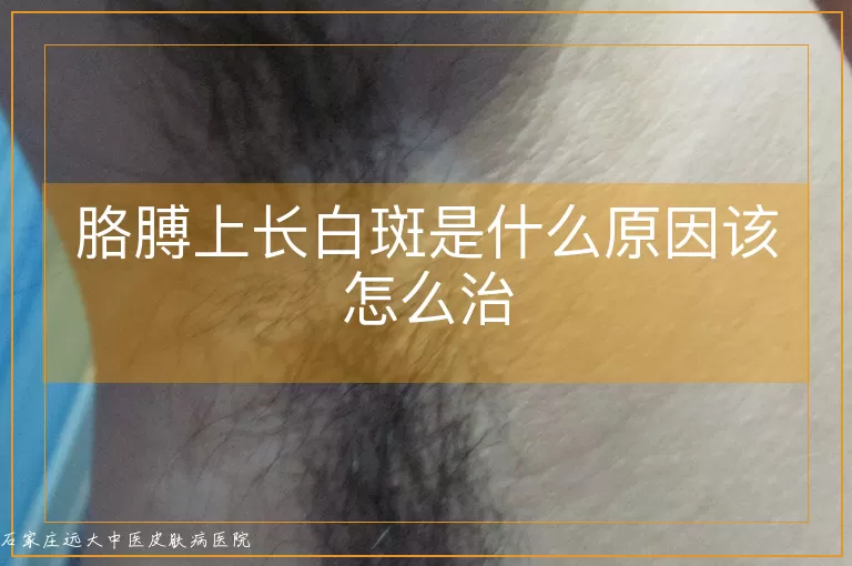 胳膊上长白斑是什么原因该怎么治