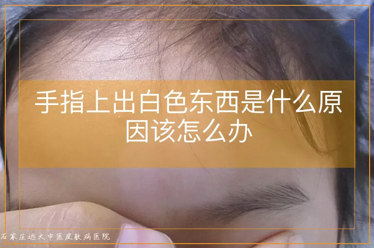 手指上出白色东西是什么原因该怎么办