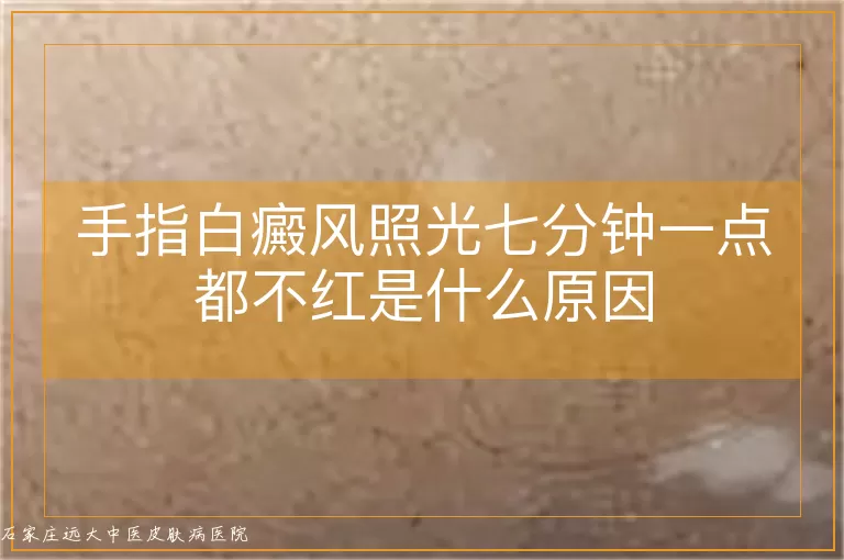 手指白癜风照光七分钟一点都不红是什么原因