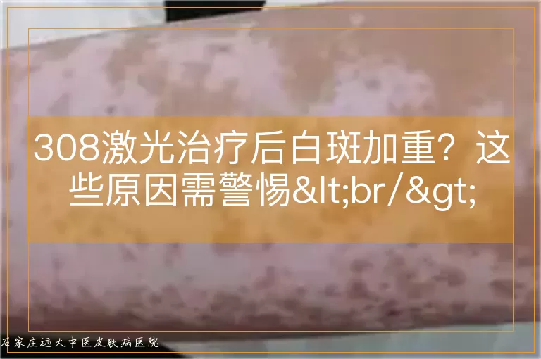 308激光治疗后白斑加重？这些原因需警惕<br/>