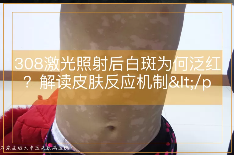 308激光照射后白斑为何泛红？解读皮肤反应机制</p>
<p>