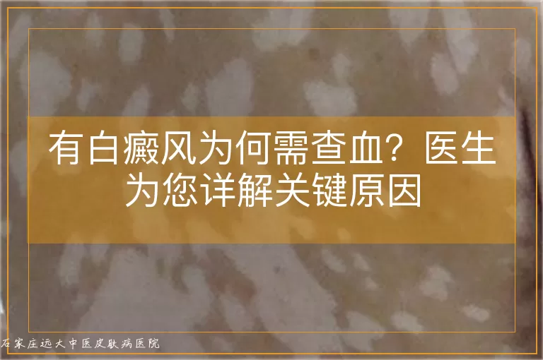 有白癜风为何需查血？医生为您详解关键原因