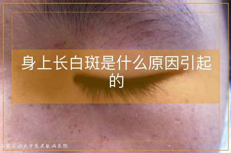 身上长白斑是什么原因引起的