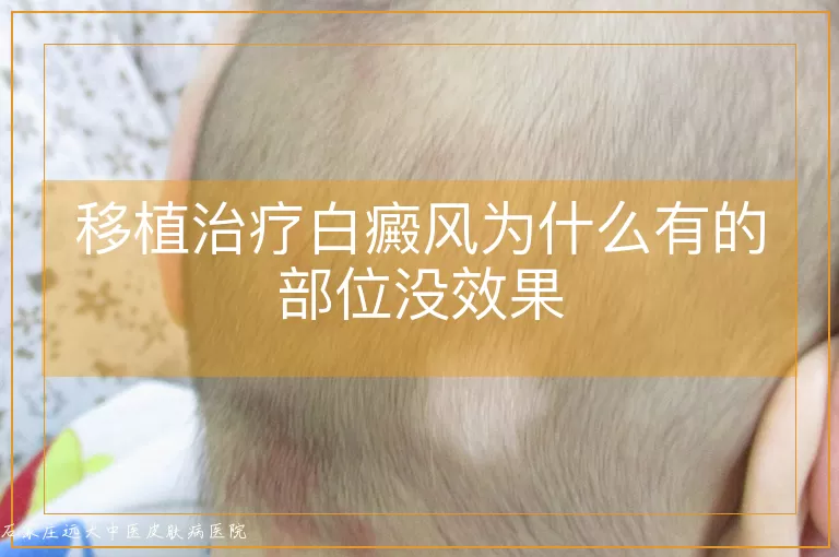 移植治疗白癜风为什么有的部位没效果