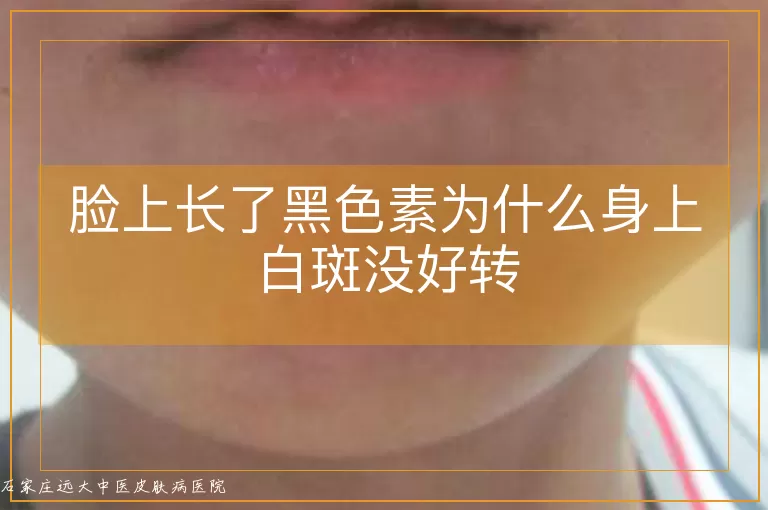脸上长了黑色素为什么身上白斑没好转
