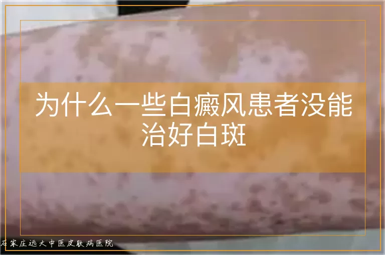 为什么一些白癜风患者没能治好白斑