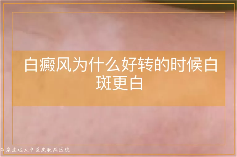 白癜风为什么好转的时候白斑更白