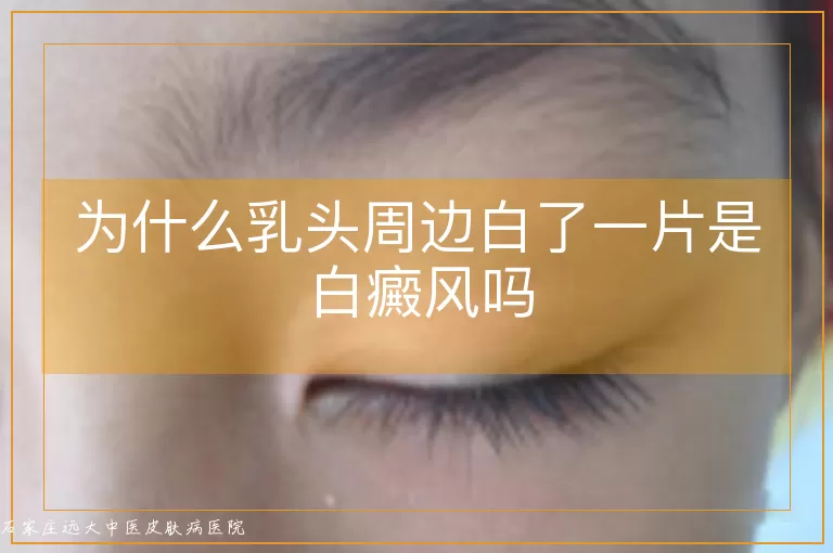 为什么乳头周边白了一片是白癜风吗