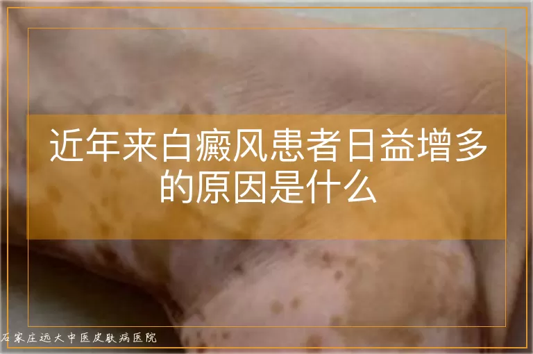 近年来白癜风患者日益增多的原因是什么