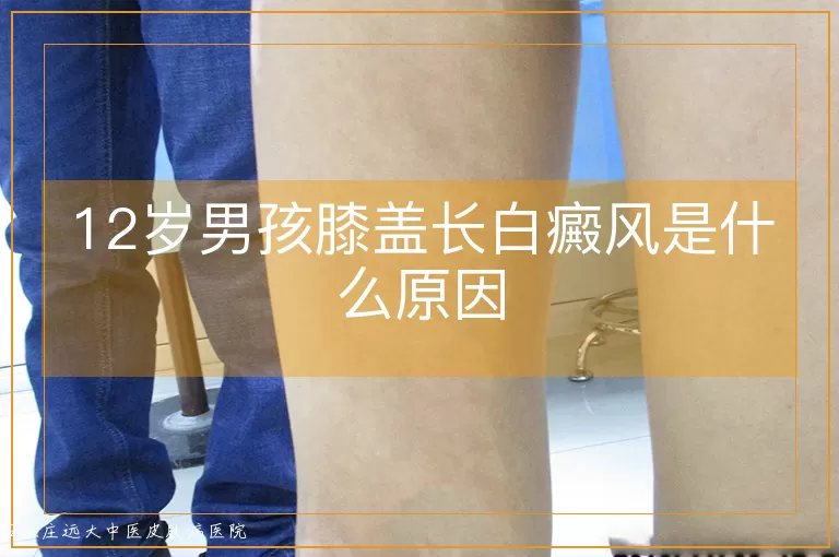 12岁男孩膝盖长白癜风是什么原因