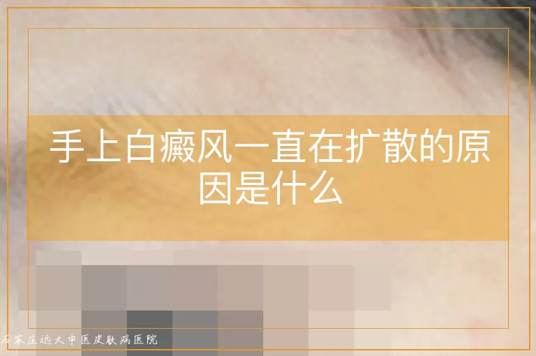 手上白癜风一直在扩散的原因是什么