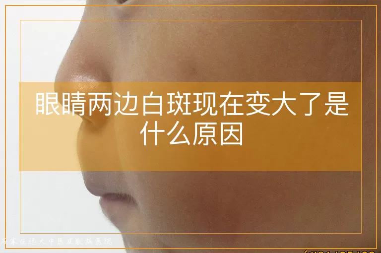 眼睛两边白斑现在变大了是什么原因