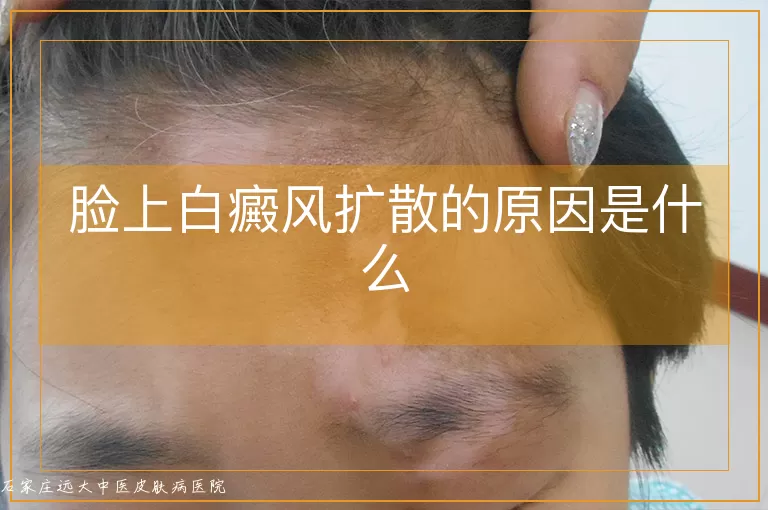 脸上白癜风扩散的原因是什么