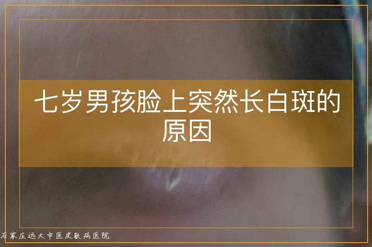 七岁男孩脸上突然长白斑的原因