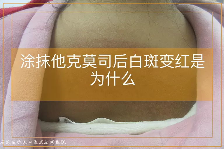 涂抹他克莫司后白斑变红是为什么