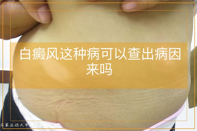 白癜风这种病可以查出病因来吗
