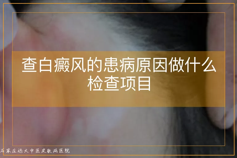 查白癜风的患病原因做什么检查项目