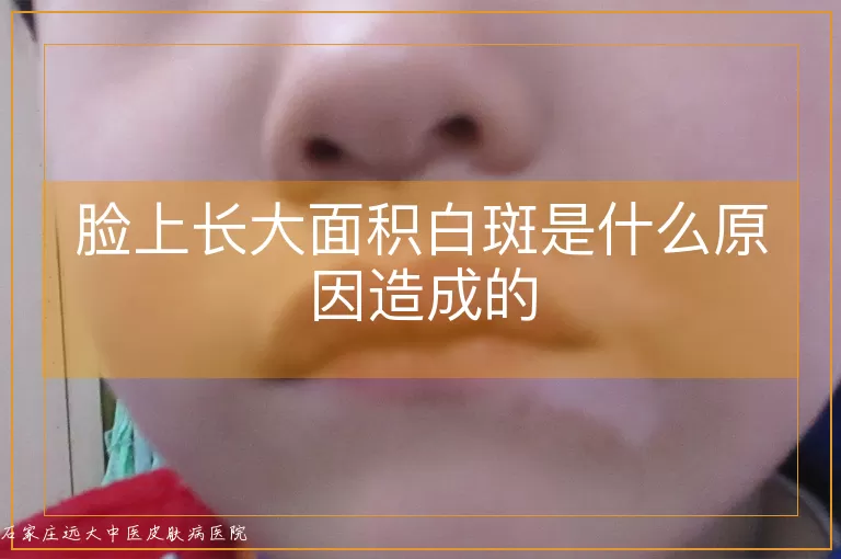 脸上长大面积白斑是什么原因造成的