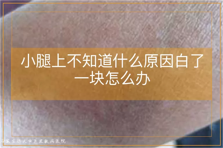 小腿上不知道什么原因白了一块怎么办