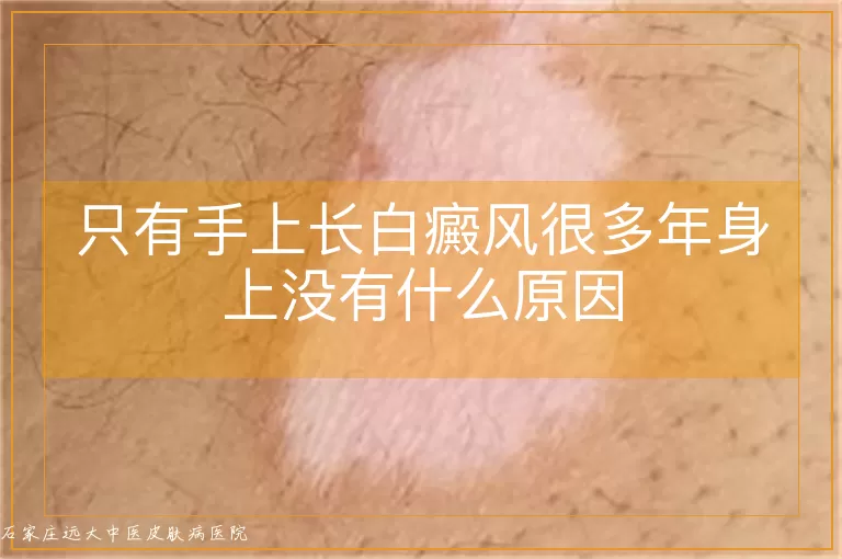 只有手上长白癜风很多年身上没有什么原因