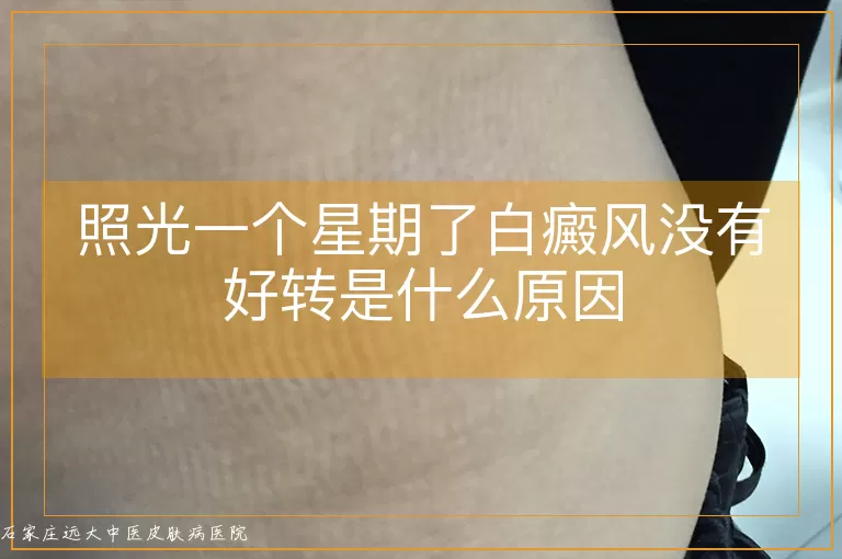 照光一个星期了白癜风没有好转是什么原因