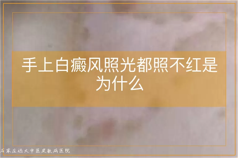 手上白癜风照光都照不红是为什么