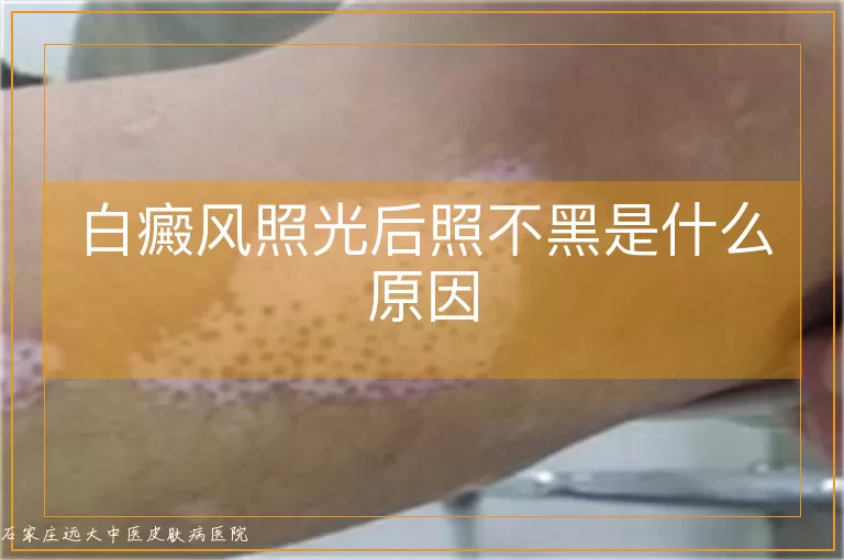 白癜风照光后照不黑是什么原因