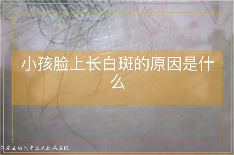 小孩脸上长白斑的原因是什么
