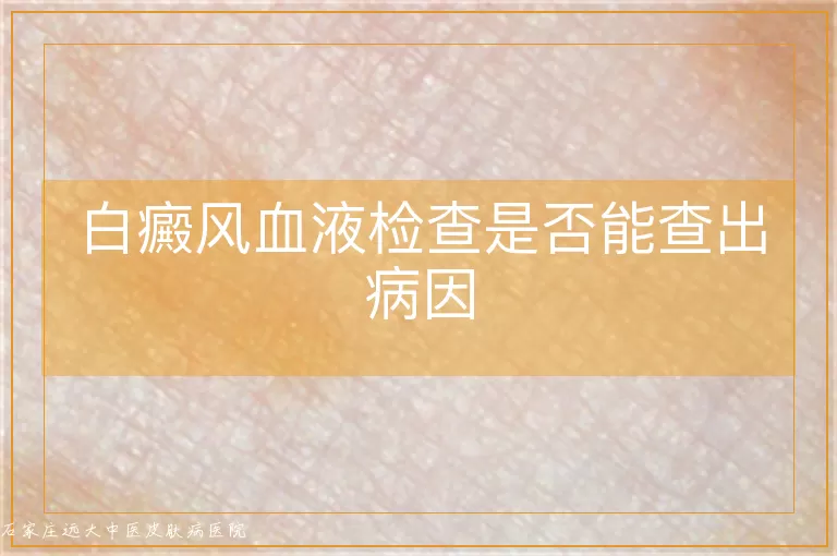 白癜风血液检查是否能查出病因