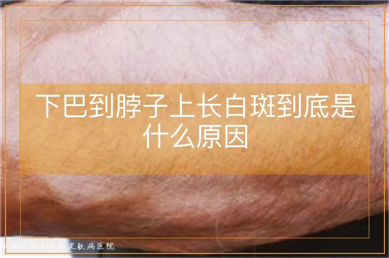 下巴到脖子上长白斑到底是什么原因